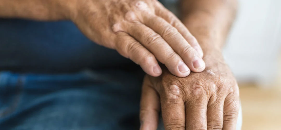 Close-up of an elderly person's hands, one resting on top of the other, showing signs of psoriatic arthritis